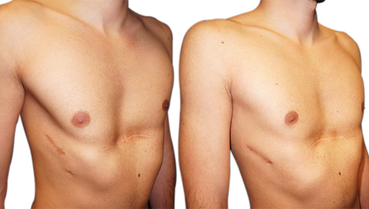 Before/after picture of a Ravitch and Nuss redo on a Pectus Excavatum Before/after picture of a Ravitch and Nuss redo on a Pectus Excavatum