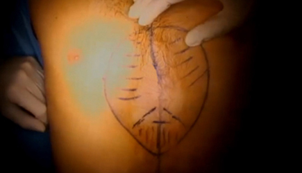 Photo of the beginning of the surgery with the pre-operative drawing Photo of the beginning of the surgery with the pre-operative drawing