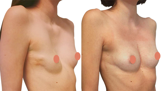 Before/after picture of a woman's sunken chest surgery Before/after picture of a woman's sunken chest surgery