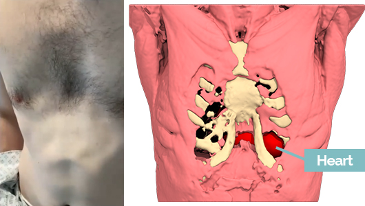 Ravitch failure for Pectus Excavatum correction with visible apex beat on real life and on 3D design Ravitch failure for Pectus Excavatum correction with visible apex beat on real life and on 3D design
