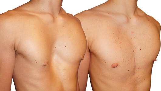 Before/after picture of a man's sunken chest surgery Before/after picture of a man's sunken chest surgery