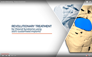 Poland Syndrome treatment using 3D custom-made implants 
