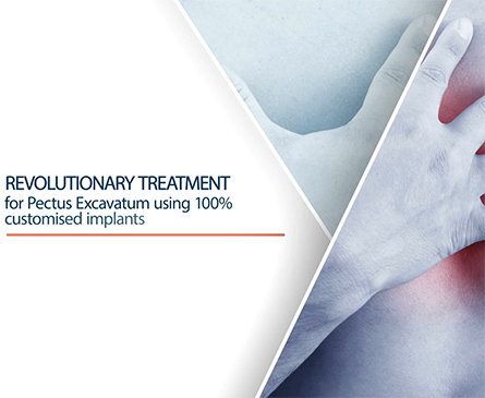 Pectus Excavatum treatment using 3D custom-made implants Video