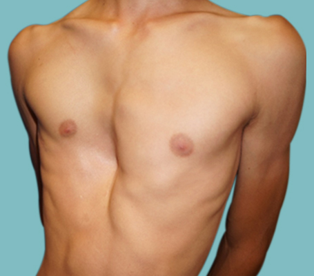 Pectus Excavatum