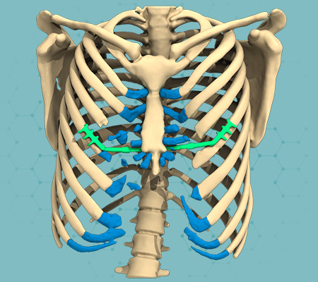 3D design view of a failed Ravitch Technique on a Pectus Excavatum