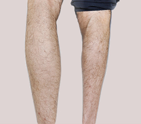 Back view of the calf atrophy of the right leg