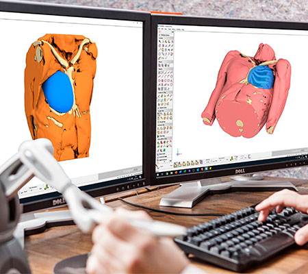 3D custom-made implant design of Poland Syndrome