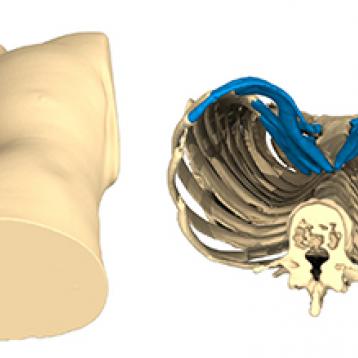Pectus Excavatum case of the month