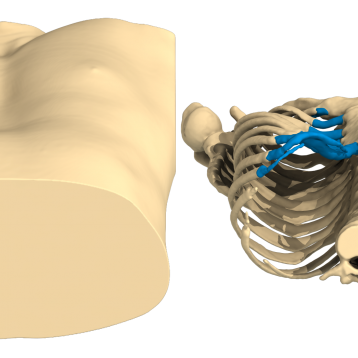 Pectus Excavatum case of the month