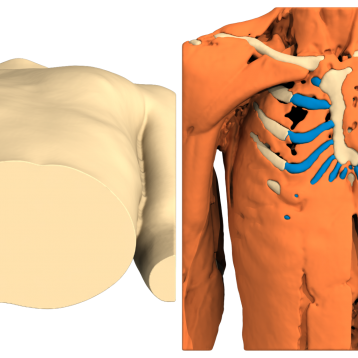 Poland Syndrome case of the month