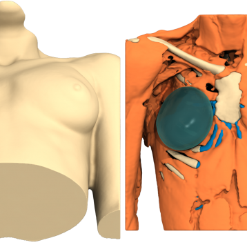 Poland Syndrome case of the month
