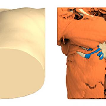 Poland Syndrome case of the month