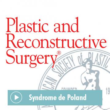 PRS Poland Syndrome treatment Plastic and Reconstructive Surgery Journal article on Poland Syndrome
