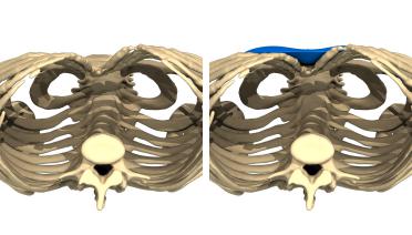 Woman - Pectus Type 1 - 3 months later - 3D view