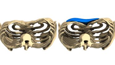 Woman - Pectus Type 3 -3 months later - 3D view
