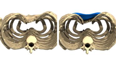 Man - Pectus type 1 - 1 year later - 3D view