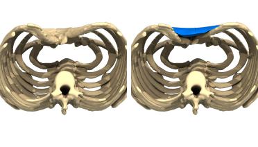 Man - Pectus type 2 - 3 months later - 3D view