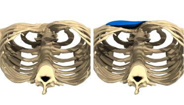 Man - Pectus type 3 - 3 months later - 3D view