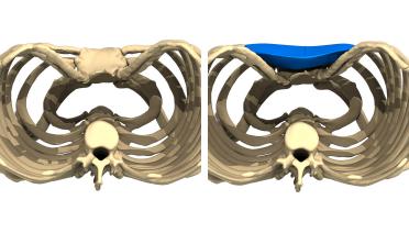Man - Pectus type 4 - 1 year later - 3D view