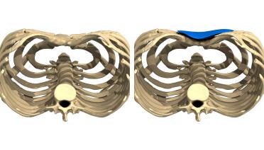 Man - Pectus type 5 - 1 year later - 3D view