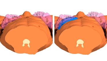 Woman - Poland Type 1 - 3 months later - 3D view