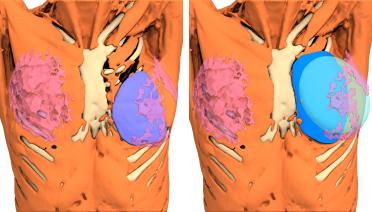 Woman - Poland Type 3 - 1 year later - 3D view