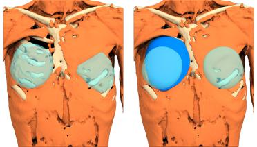 Woman - Poland Type 4 - 1 year later - 3D view