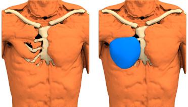 Man - Poland type 1 - 1 year later - 3D view
