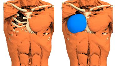Man - Poland type 2 - 3 months later - 3D view