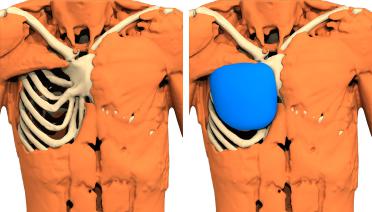 Man - Poland type 3 - 3 months later - 3D view