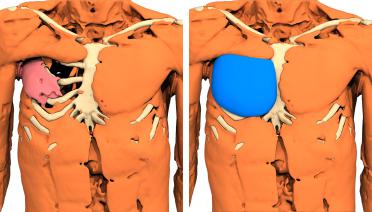Man - Poland type 4 - 3 months later - 3D view
