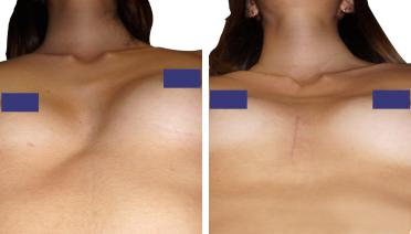 Woman - Pectus Type 3 -3 months later - low angle view