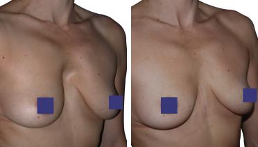 Woman - Pectus Type 4 - 1 year later - side view
