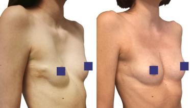 Woman - Pectus Type 5 -2 years later - side view