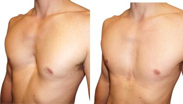 Man - Pectus type 1 - 1 year later - side view