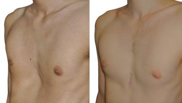 Man - Pectus type 2 - 3 months later - side view