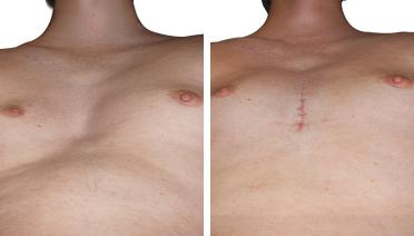 Man - Pectus type 3 - 3 months later - low angle view