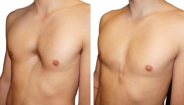 Man - Pectus type 4 - 1 year later - side view