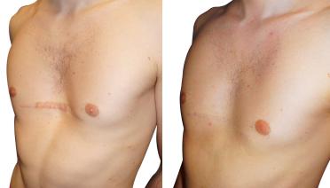 Man - Pectus type 5 - 1 year later - side view