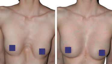 Woman - Pectus Type 1 - 3 months later - front view