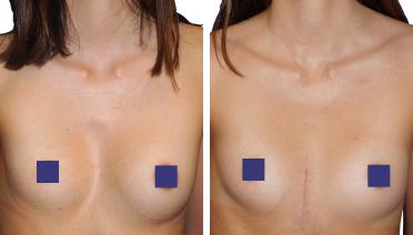 Woman - Pectus Type 3 -3 months later - front view