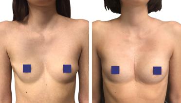 Woman - Pectus Type 5 -2 years later - front view