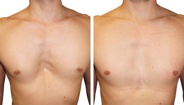 Man - Pectus type 1 - 1 year later - front view