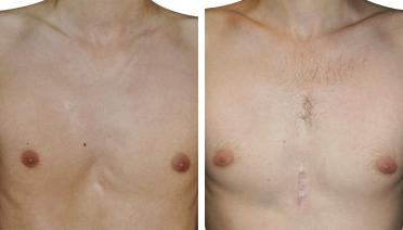 Man - Pectus type 2 - 3 months later - front view