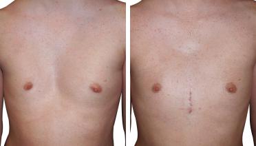 Man - Pectus type 3 - 3 months later - front view