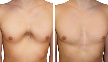 Man - Pectus type 4 - 1 year later - front view